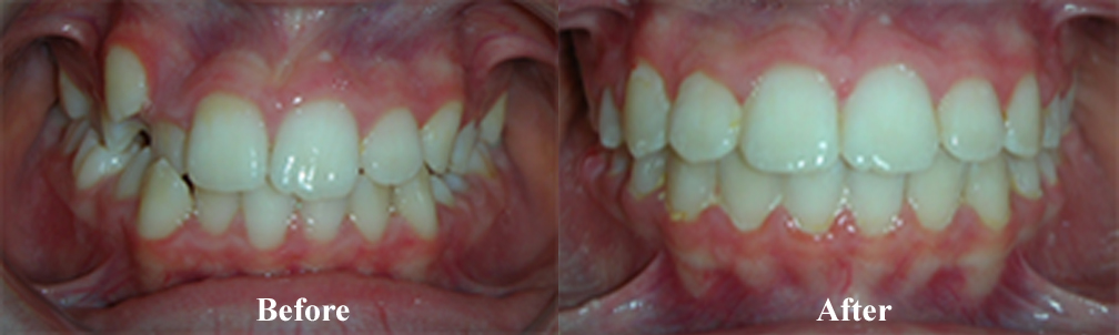 Picture of a Crowding Correction
