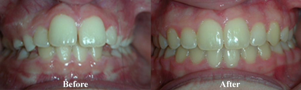 Picture of another Crowding Correction