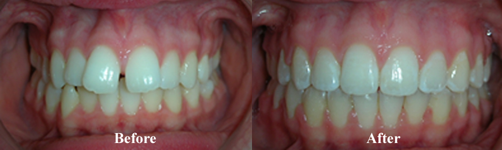 Picture of a Spacing Correction