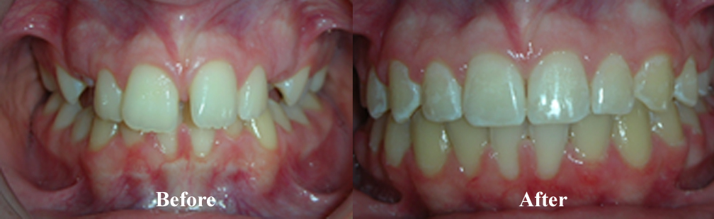 Picture of another Spacing Correction