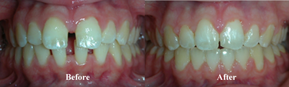 Picture of a third Spacing Correction