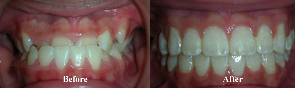 Picture of Underbite Correction